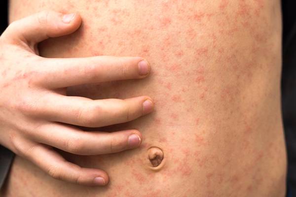 Florida county sees outbreak of measles at elementary school