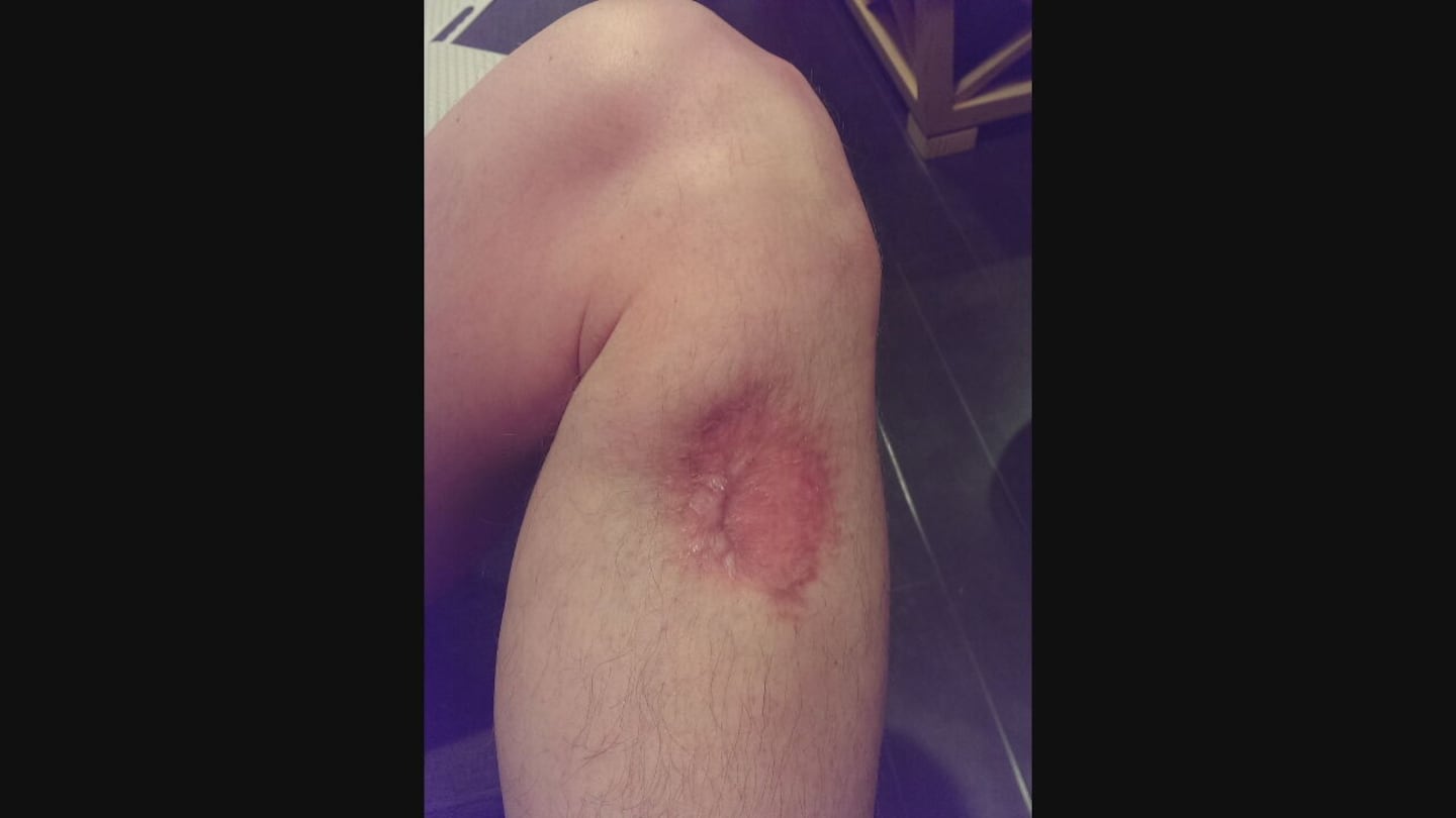 The scar left from Kevin Spencer's first melanoma removal surgery